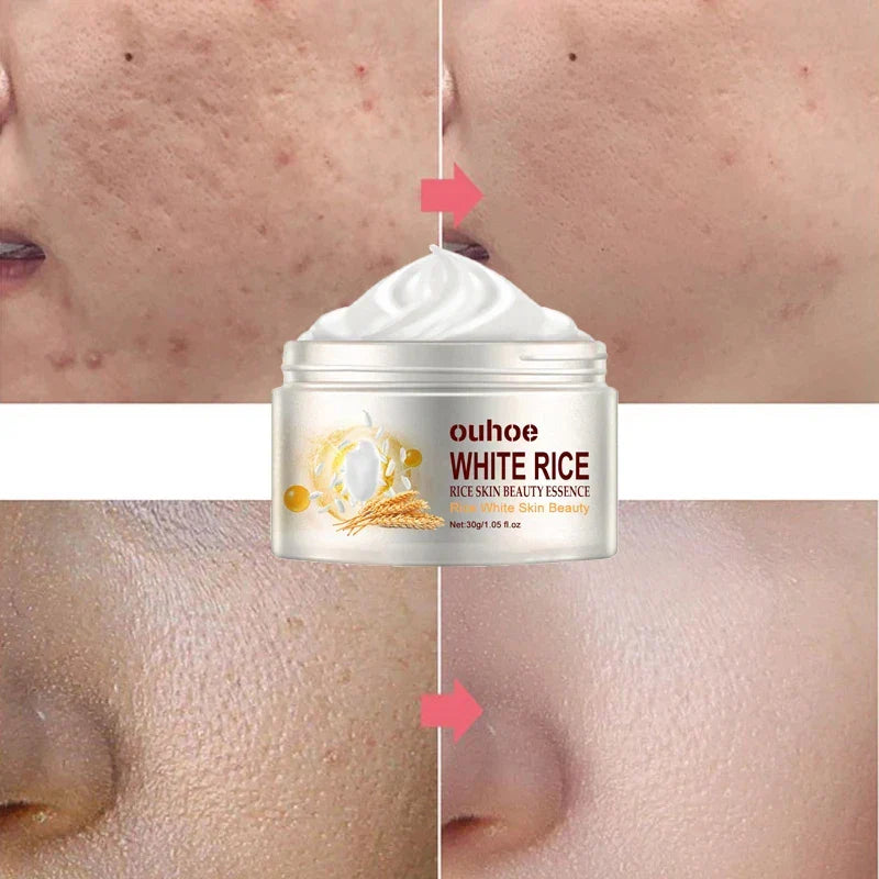 Facial Cream Acne Melasma Treatment Pigmentation Whitening Face Lifting Beauty Moisturizer Korean Cosmetics30g